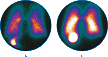 无创通气，有效给药